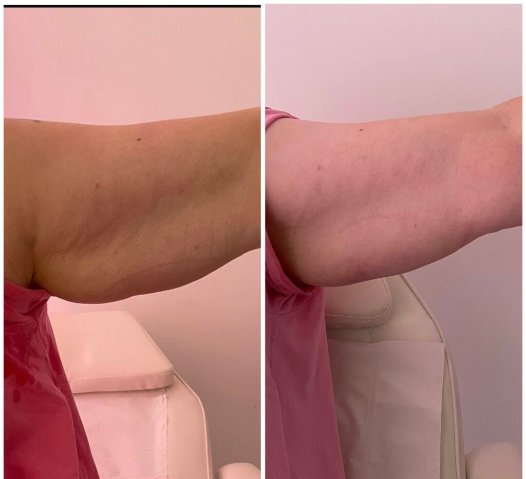 An arm Non-Invasive Body Sculpting result showing tightened and lifted skin, minimizing the appearance of sagging for a more toned look.