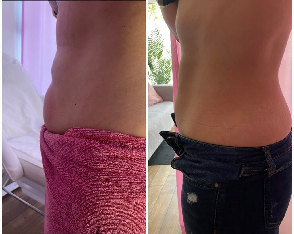 A client’s abdomen showing a noticeable reduction in fat, achieving a smoother and more toned look after non-invasive body sculpting treatments.