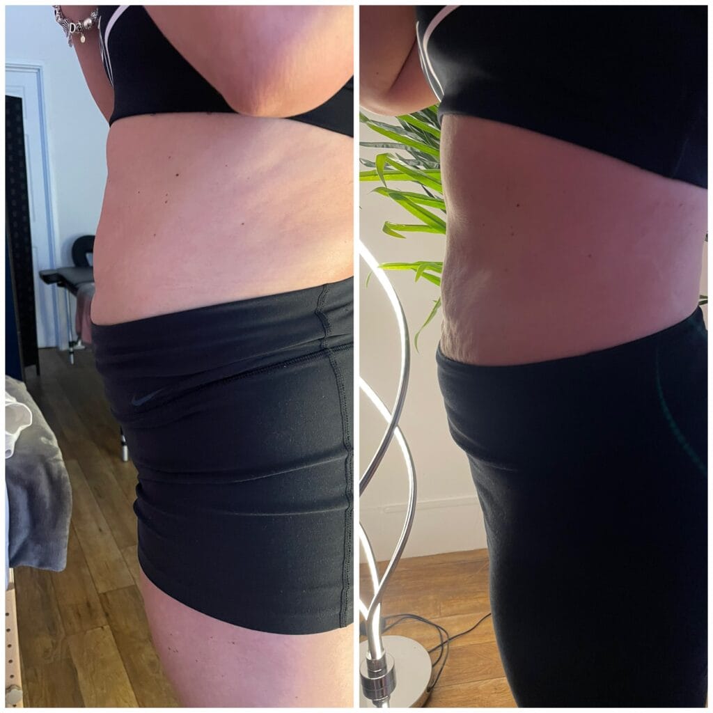 A significant transformation in the abdominal area, showcasing tightened skin and improved contours for a leaner appearance.