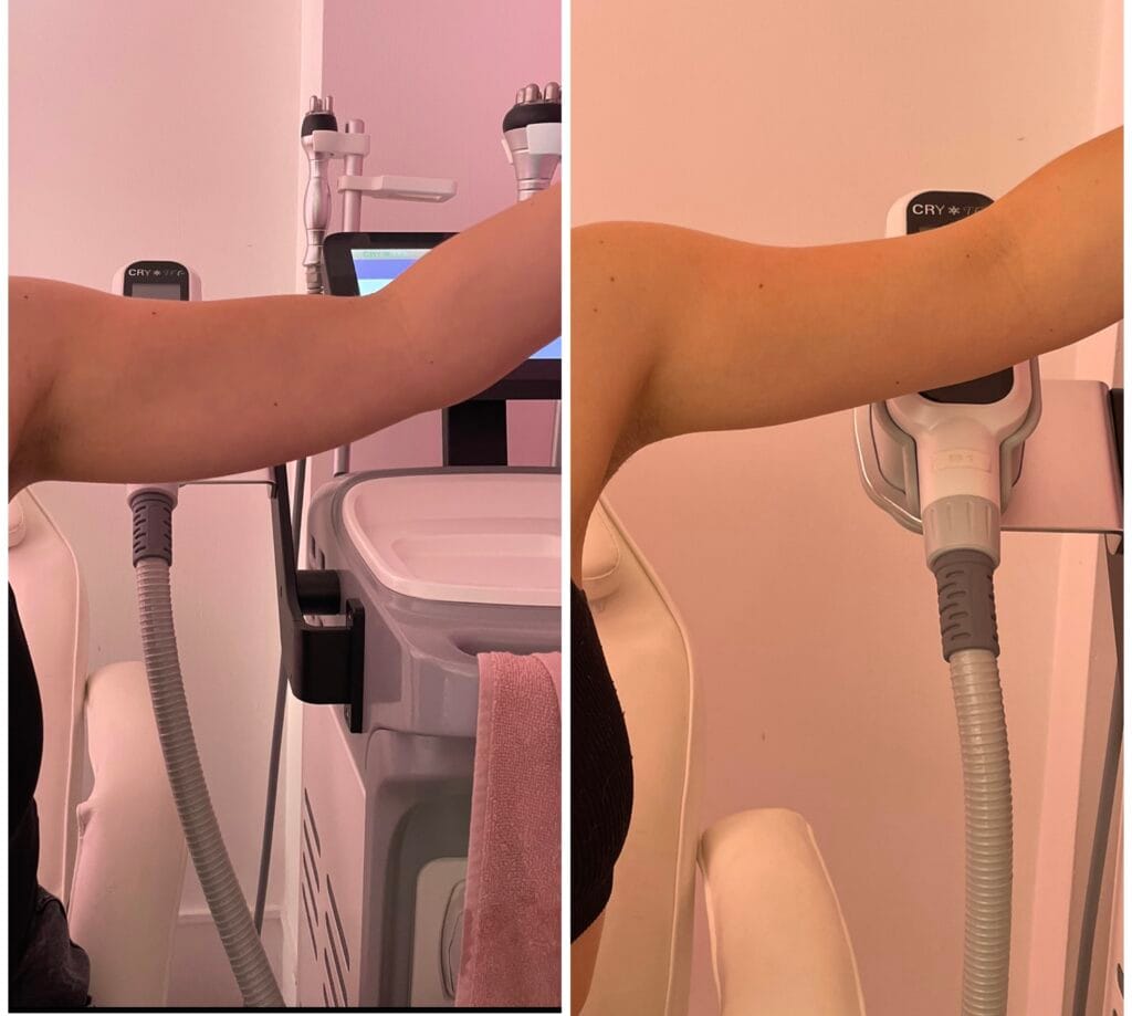 An arm treatment with reduced flabbiness, revealing firmer and smoother skin after the sculpting sessions.