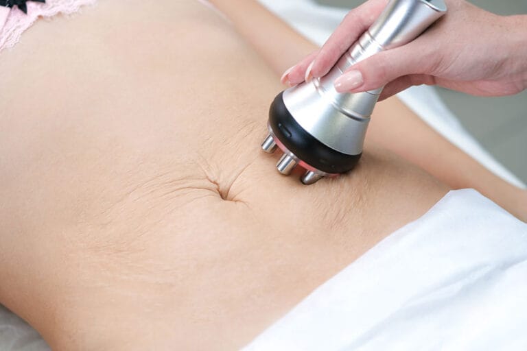 Close-up of a non-invasive RF Skin Tightening device applied to the abdomen area, promoting skin elasticity.